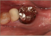 インプラント手術前の口腔内写真