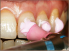 歯の外側面・噛む面の清掃研磨